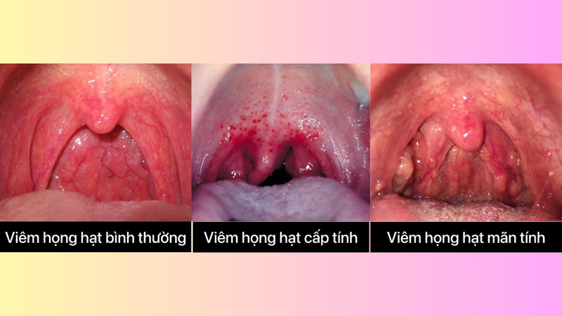 Hình ảnh viêm họng hạt ở cuống lưỡi và những điều cần quan tâm về viêm họng hạt