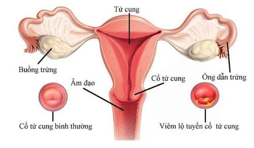 Bệnh viêm lộ tuyến cổ tử cung có nguy hiểm không?