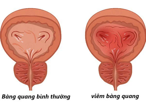 Viêm bàng quang: Nguyên nhân, dấu hiệu nhận biết, cách phòng ngừa