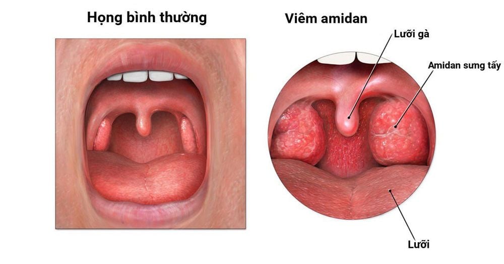 Viêm họng cấp là gì?