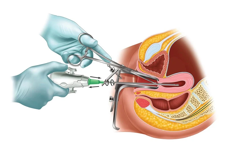 Mọi điều cần biết về bệnh viêm phần phụ