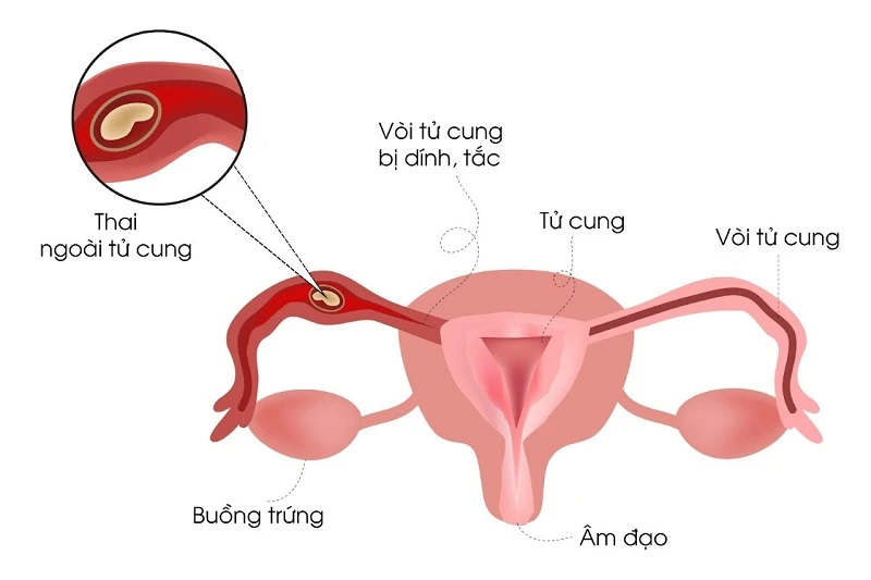 Mọi điều cần biết về bệnh viêm phần phụ