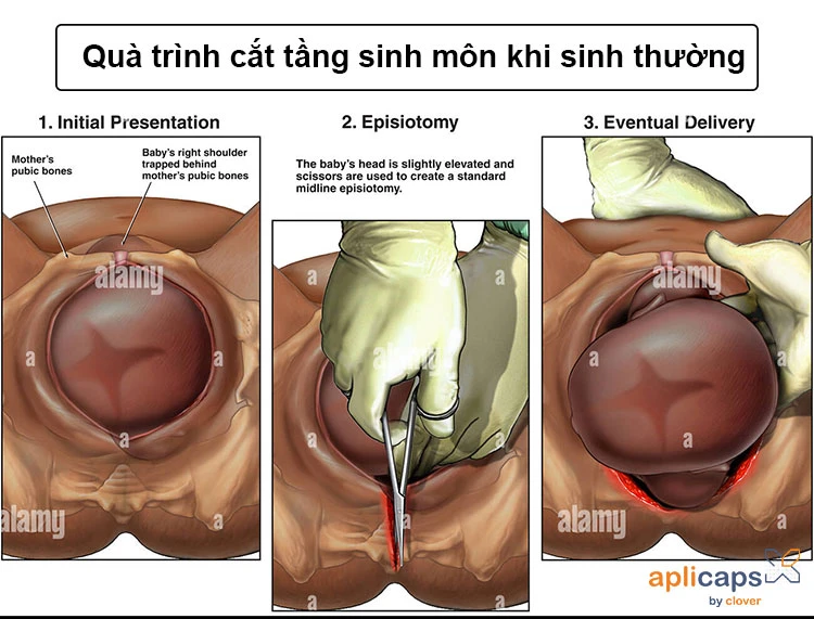 10+ hình ảnh vết khâu tầng sinh môn - Phân biệt vết khâu lành và bị hở