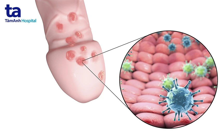 Nổi mụn trắng ở bao quy đầu cảnh báo bệnh gì? Nguyên nhân và dấu hiệu