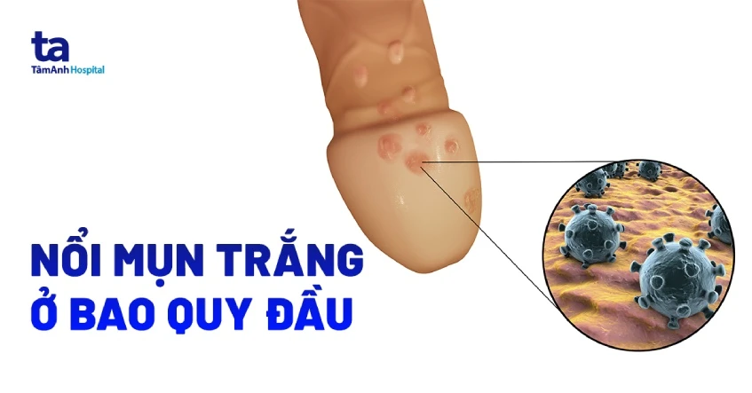 Nổi mụn trắng ở bao quy đầu cảnh báo bệnh gì? Nguyên nhân và dấu hiệu