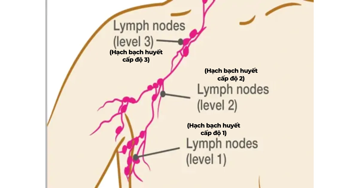 Cảnh báo dấu hiệu nổi hạch ở nách bạn cần chú ý