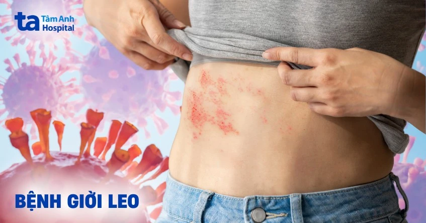 Bệnh giời leo: Nguyên nhân, dấu hiệu, chẩn đoán, phòng ngừa