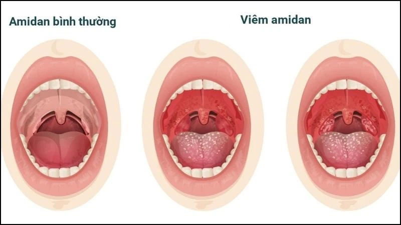 Hình ảnh viêm họng hạt trắng